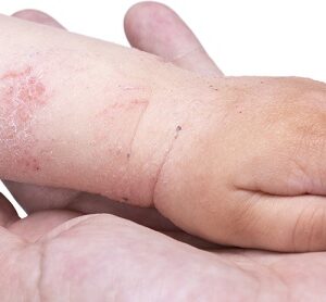 MON ENFANT A DE L’ECZÉMA
